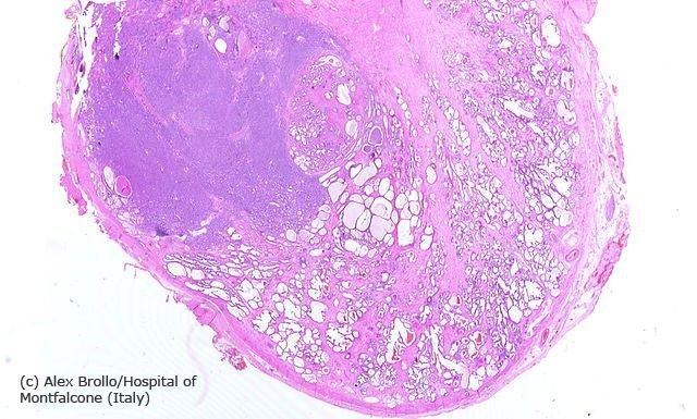 Diagnose Prostatakrebs: Was heißt das? Prostata Hilfe Deutschland: Illustrationsbild für Diagnose Prostatakrebs - Schnitt durch eine Prostata: Adenokarzenom (links)