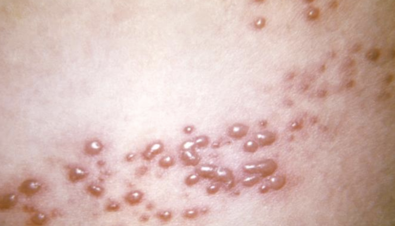 Gürtelrose (Herpes Zoster) mit typischem Hautausschlag und Bläschen