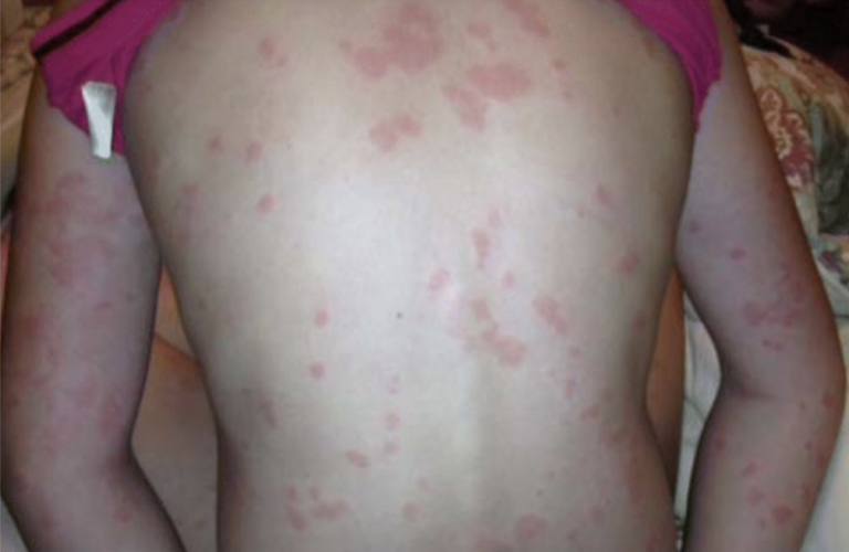 Urtikaria auf dem Rücken – typische Hautausschläge und Quaddeln