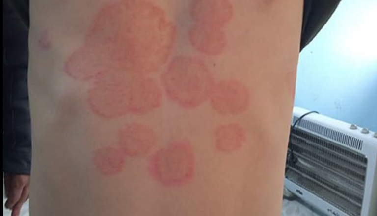 Tinea-Infektion auf menschlicher Haut mit typischen roten, runden Hautveränderungen