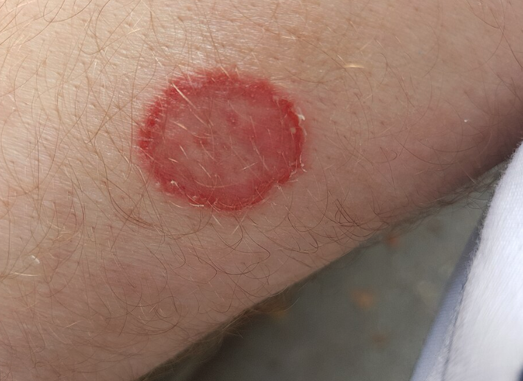 Dermatophytosis: Symptome und Erscheinungsbild auf der Haut Dermatophytosis auf menschlicher Haut, typische ringförmige Rötung