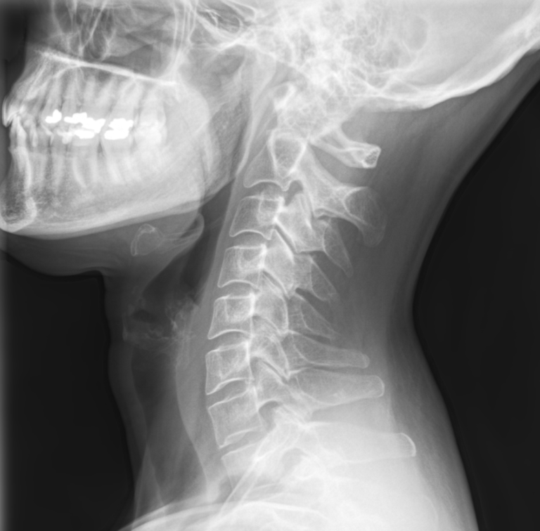 HWS auf Röntgenbild – seitliche Aufnahme der Halswirbelsäule